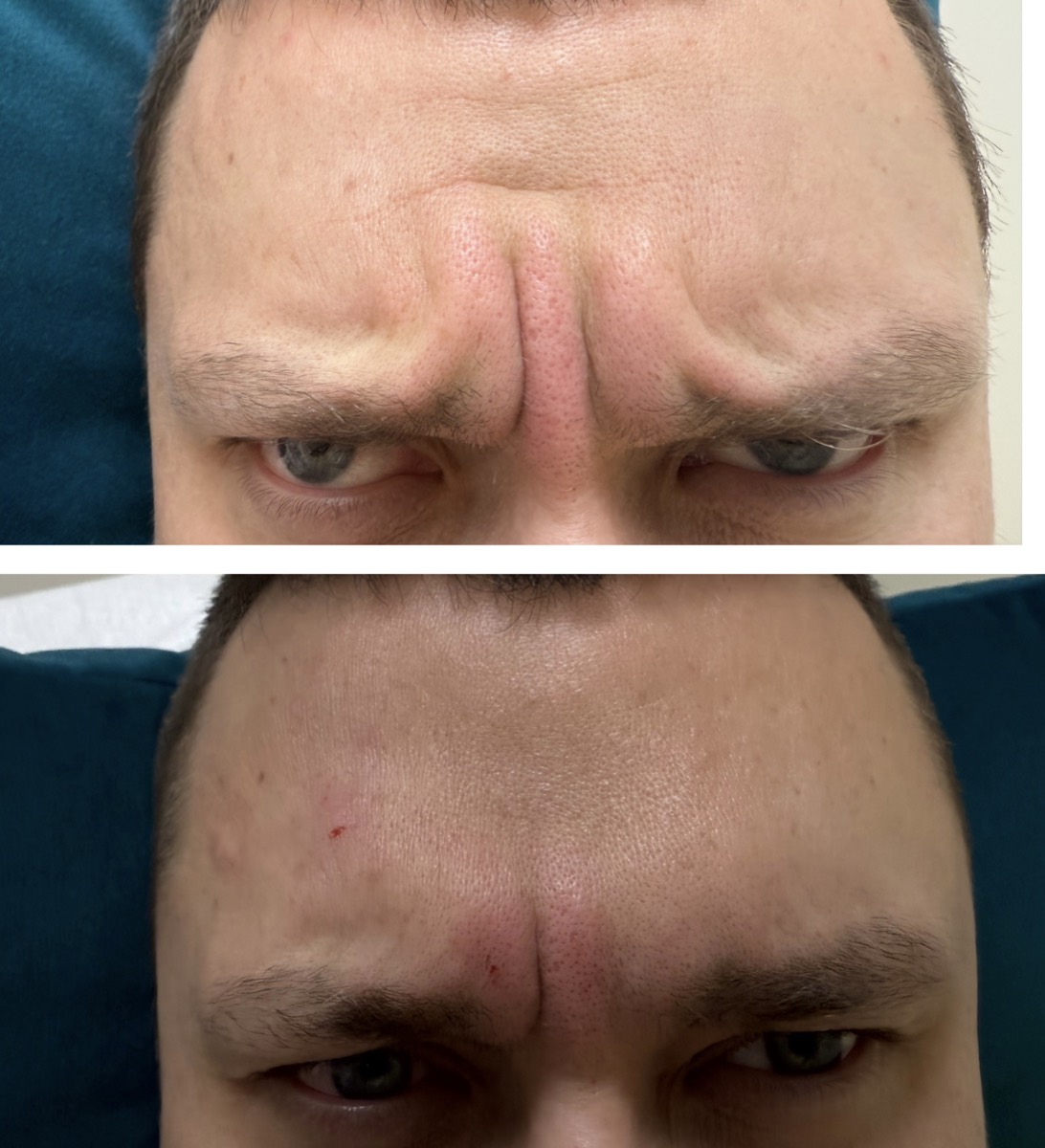 Frown Lines before and after at Aesthetics by Ilona, Brooklyn