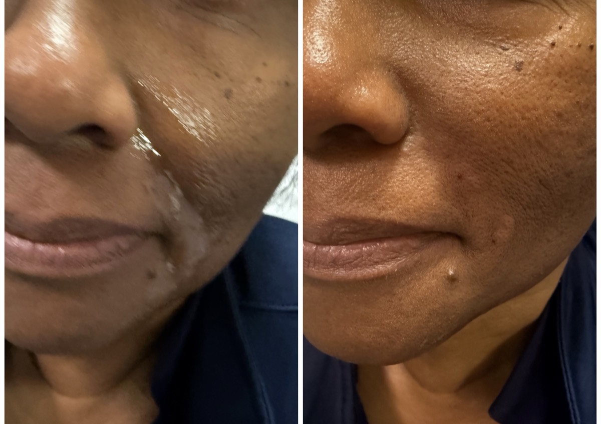 Before and after — Skin Rejuvenation