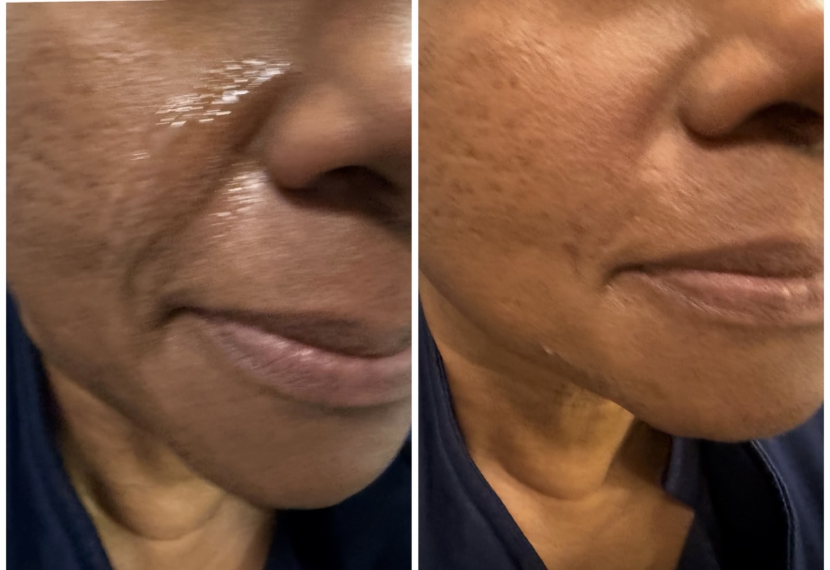 Before and after — Texture & Tone