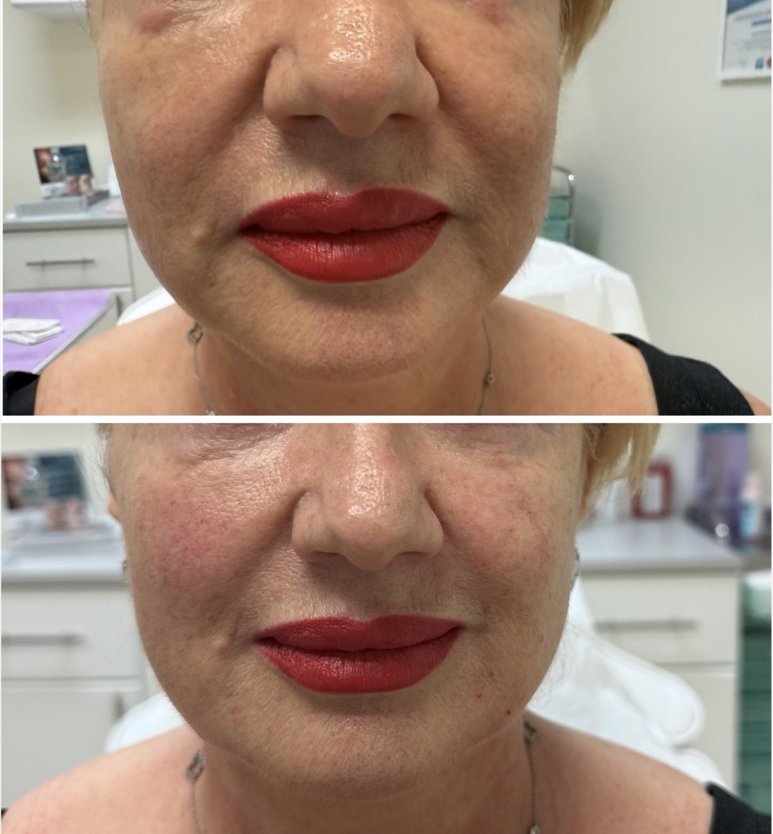 Before and after — Lip & Nasolabial