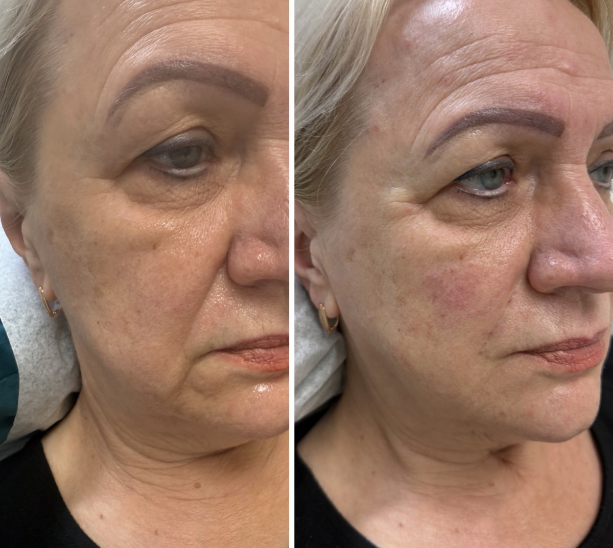 Before and after — Under-Eye & Cheek Lift