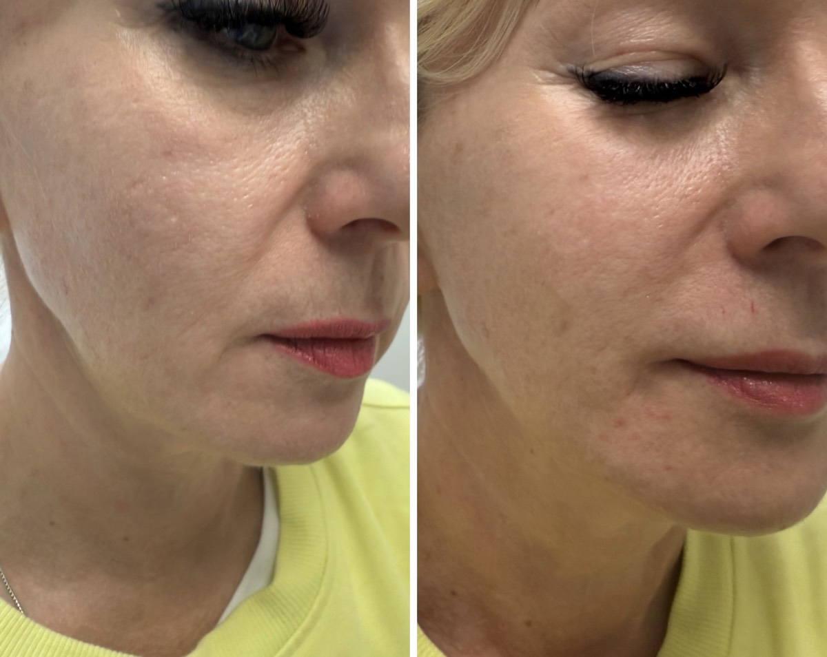 Before and after — Jawline Lift