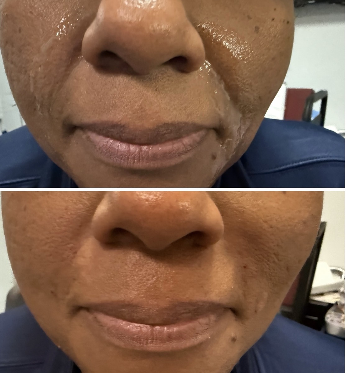 Before and after — Nasolabial Folds