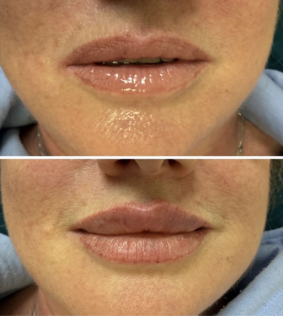 Before and after — Lip Filler