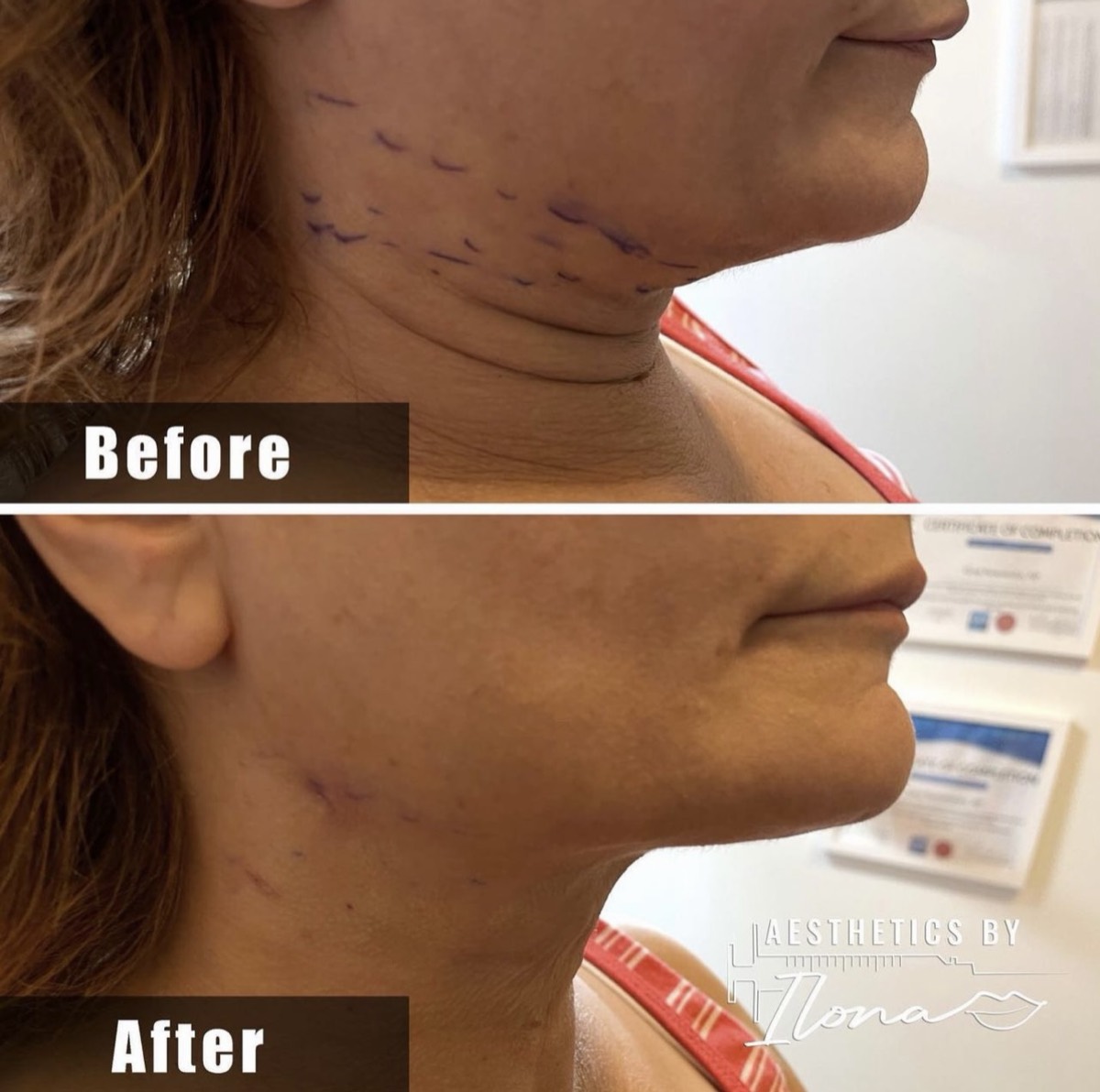 Before and after — Neck & Jawline