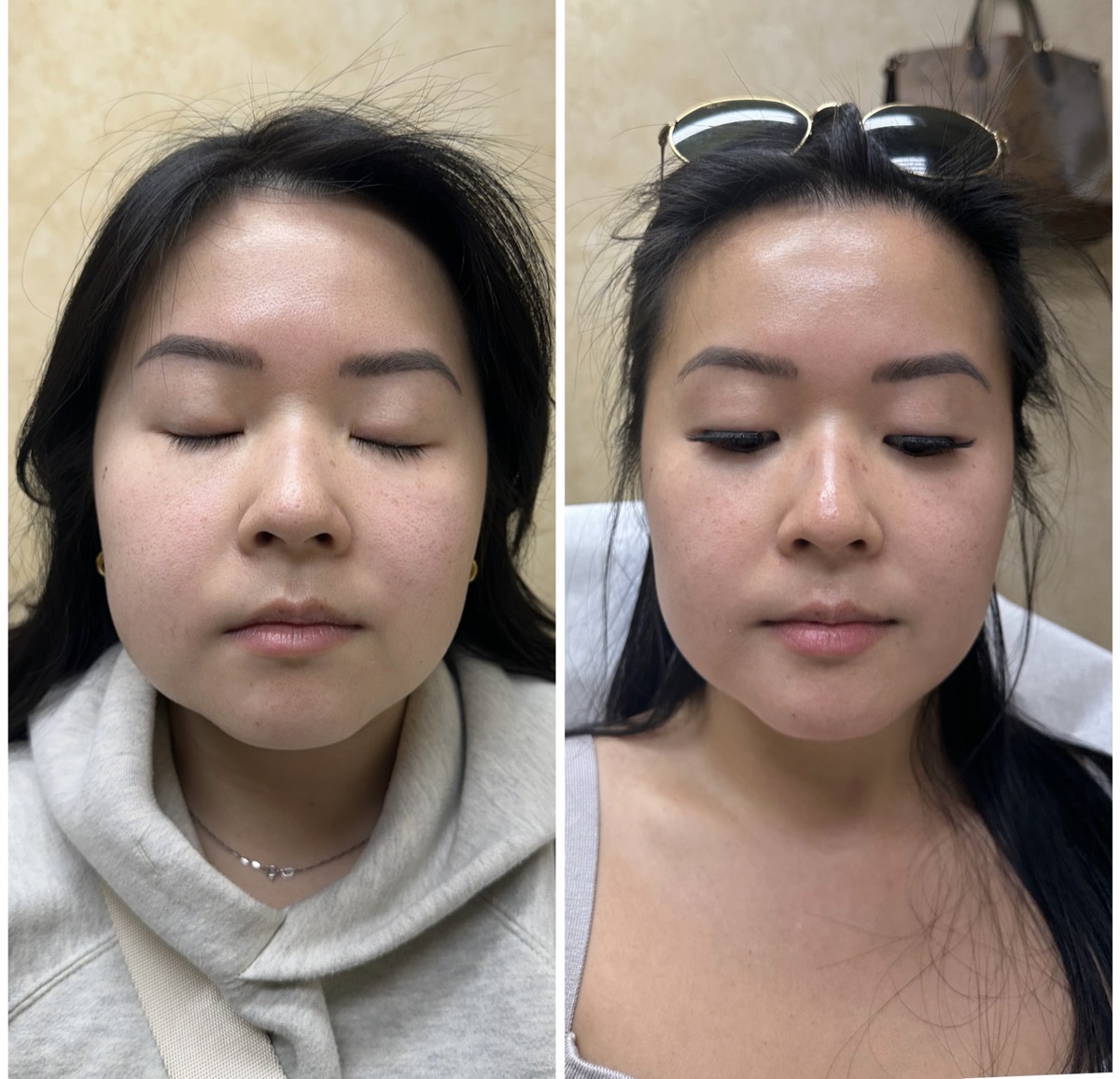 Before and after — Forehead & Brow