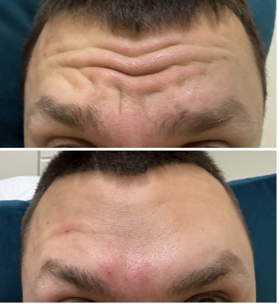 Before and after — Forehead Lines