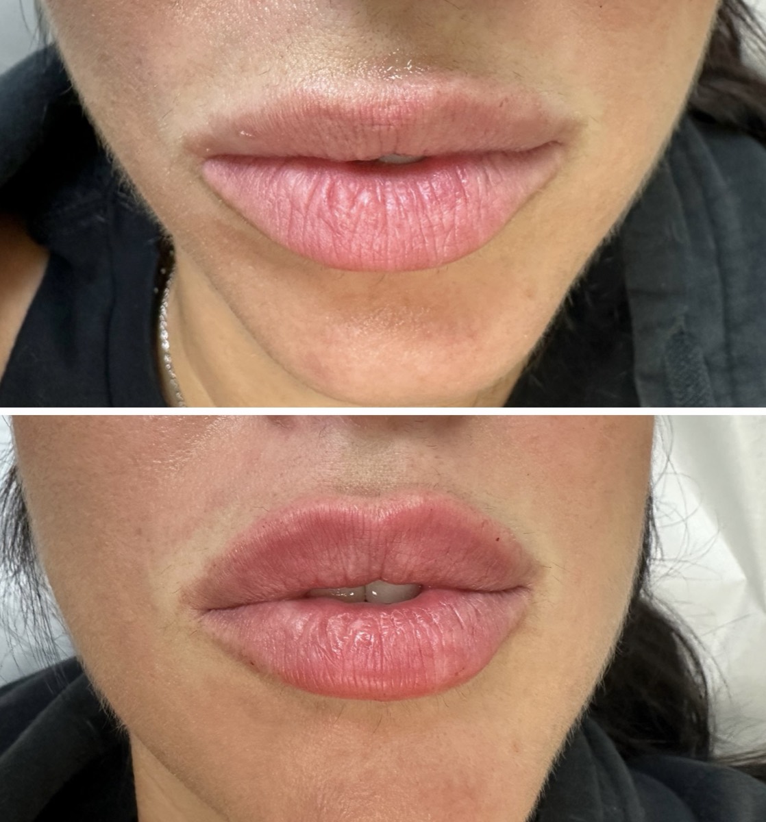 Lip Filler before and after at Aesthetics by Ilona, Brooklyn