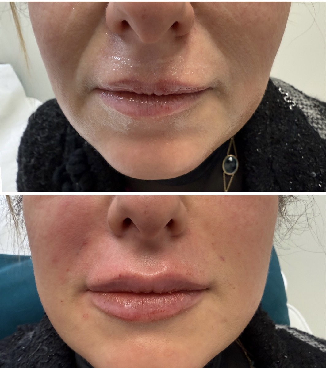 Before and after — Lip Filler