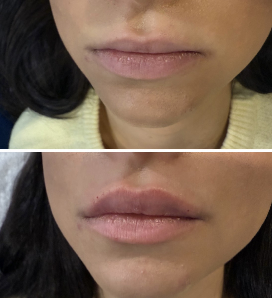 Before and after — Lip Enhancement