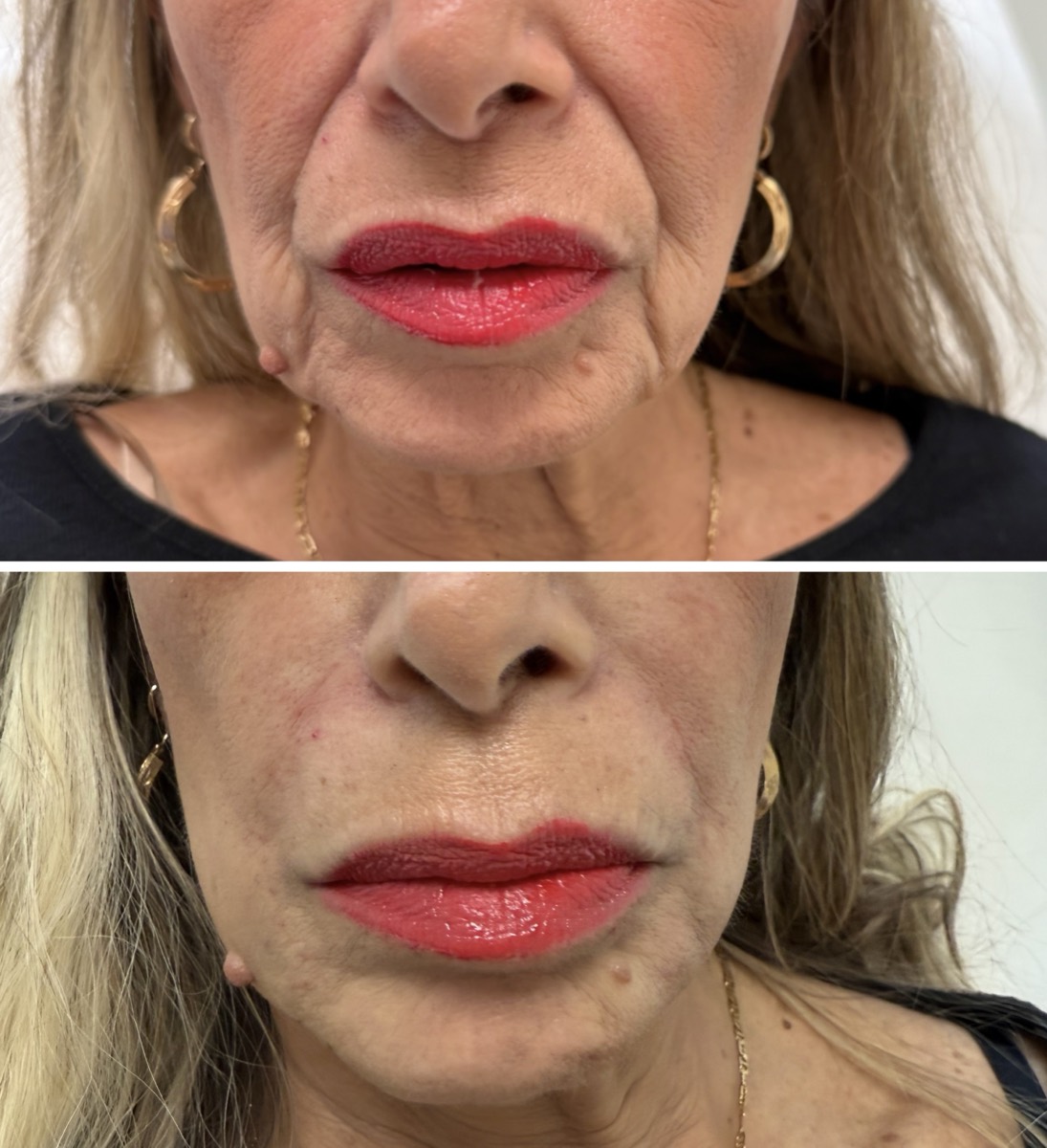 Before and after — Lip Filler