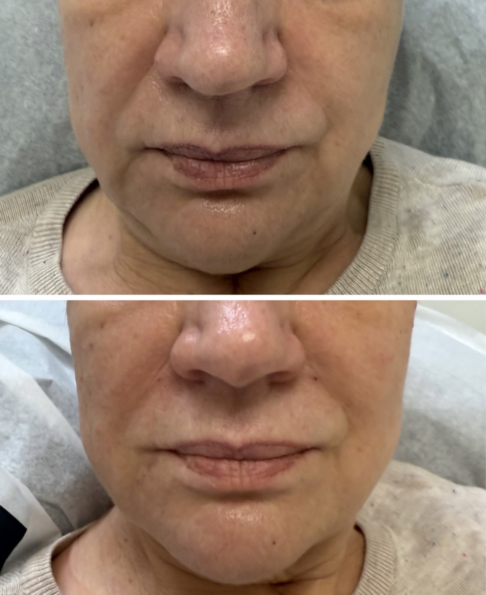 Before and after — Nasolabial Folds