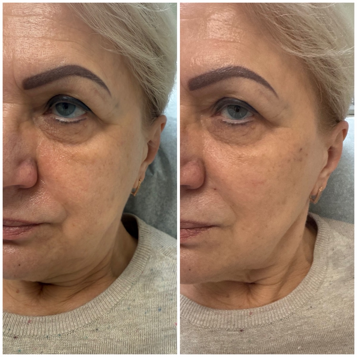 Mid-Face Lift before and after at Aesthetics by Ilona, Brooklyn