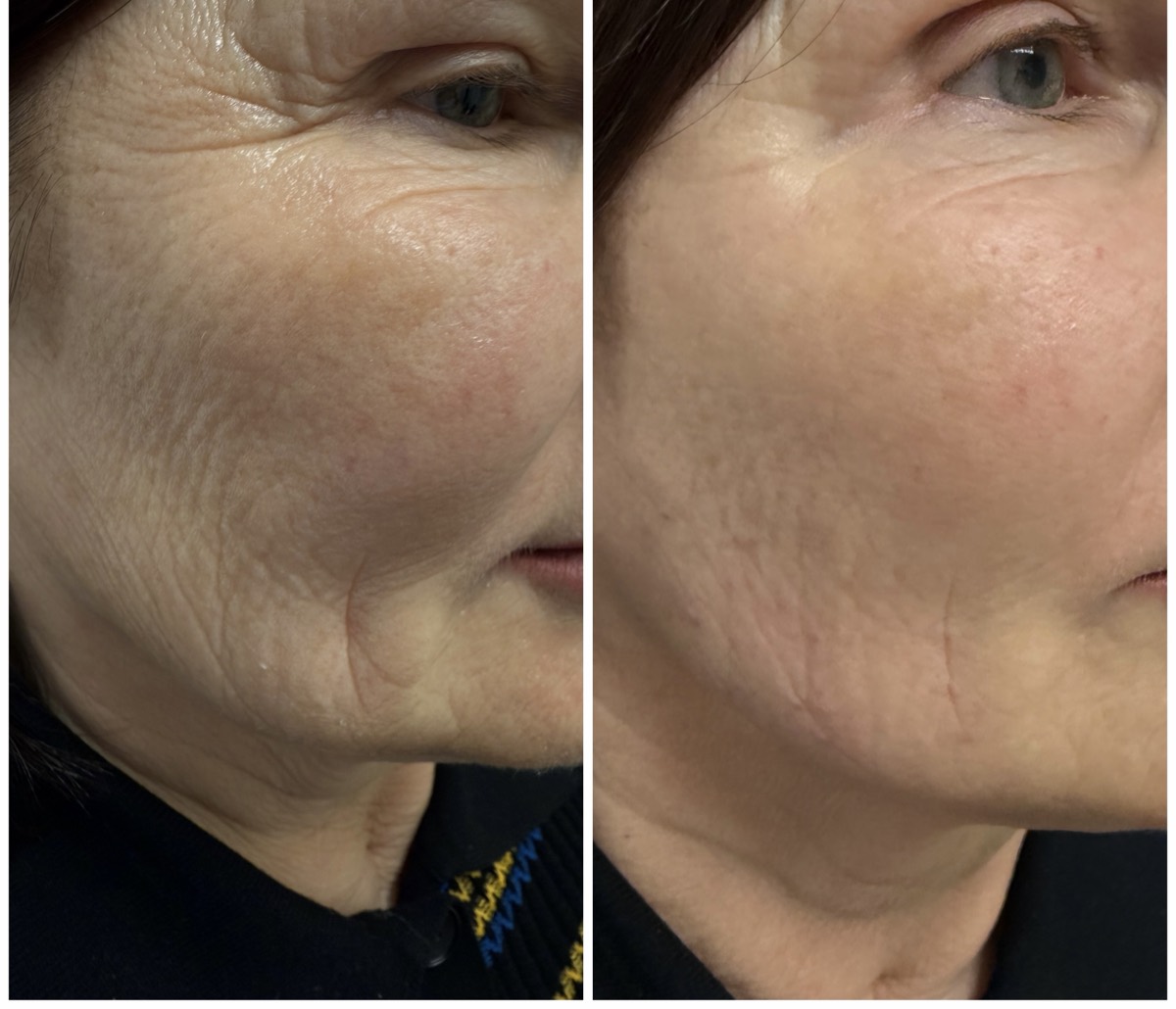 Before and after — Jawline & Cheek Lift